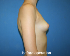 plastic-surgery-breast-augmentation